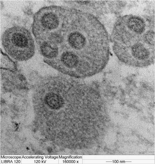세포 내에 있는 국내 메르스 바이러스 전자현미경 사진. 보건복지부 제공